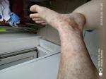 Кровяные высыпания на ногах, диагноз Васкулит не могут поставить фото 1