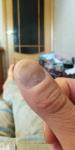 Деформация ногтей на руках, но только на больших пальцах, почему? фото 1