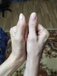 Воспаление сустава большого пальца фото 4