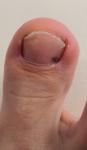 Чёрные точки на ногте на ноге фото 1