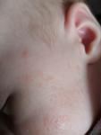 Мелкая сыпь на лице и шершавые щёки у грудничка фото 1