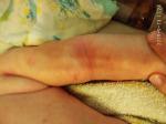 7 месяцев мальчик красные пятна по всему телу фото 4