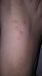 Аллергия на ногах фото 2