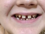 Мало зубов у подростка фото 1