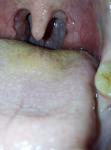 Заболевание горла, в горле шишка, появились язвы на шишке фото 2