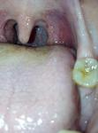 Заболевание горла, в горле шишка, появились язвы на шишке фото 1