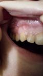 Стоматит, инфекция с язвами во рту фото 2