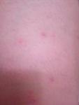 На теле появляются следы как от укуса комара сильно чешутьсяне фото 1