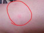 На теле появляются следы как от укуса комара сильно чешутьсяне фото 3