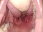 Рак миндалины горла фото 2