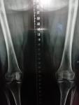 Операция на миниск колена фото 1