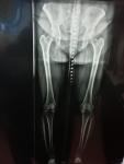 Операция на миниск колена фото 2