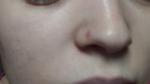 Как избавиться от болячки внутри носа? Снаружи красное пятно фото 1