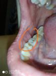 Бугры слизистой рта фото 2