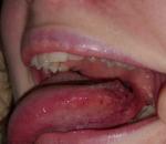 Першение в горле и болит язык сбоку фото 2