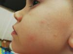 Сыпь на лице у ребенка фото 4