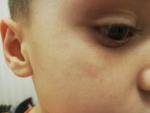 Сыпь на лице у ребенка фото 1