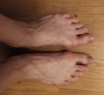 Болит в районе соединения большого пальца ноги фото 3