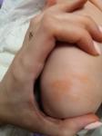 Сыпь у ребёнка 3 месяца фото 2