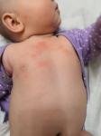 Сыпь у ребёнка 3 месяца фото 3