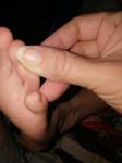 Шелушение между пальцами у ребёнка фото 1