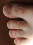 Сухость кожи пальцев рук и ног фото 4