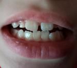 Секрет зубов по ночам и пятна на передних верхних зубах фото 1