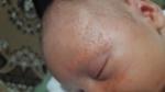 Сыпь на лице у новорожденного. Покраснения фото 1