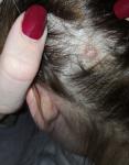 Болячка на волосистой части головы фото 1