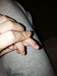 Покраснение пальца фото 1