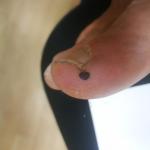 Черное пятно на большом пальце ноги фото 2
