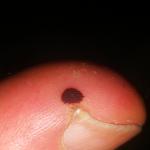 Черное пятно на большом пальце ноги фото 3