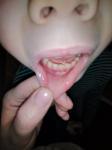 Прыщи на внутренней стороне губы и температура фото 1