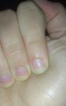 Пятнышки на ногте фото 2