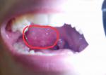 Боль и увеличение миндалины в горле фото 1