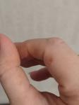Болезненные трещины на пальцах фото 1