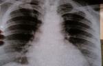 Пневмосклероз или астма? фото 1