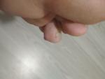 Мазоль на пальце ноги фото 2