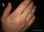 На коже рук появляются пятна каждый день, увеличиваются в размере фото 2