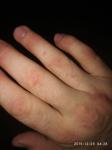 На коже рук появляются пятна каждый день, увеличиваются в размере фото 3