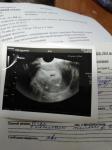 УЗИ на 6 неделе беременности фото 1
