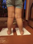 Х -образные плосковальгусная деформация коленных суставов и стоп фото 1