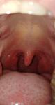 Воспален язык и горло фото 5