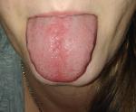 Воспален язык и горло фото 4