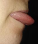 Воспален язык и горло фото 3