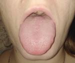 Воспален язык и горло фото 1