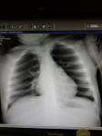 Продолжительный кашель на фоне антибиотика неоднозначный рентген фото 1