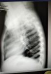 Продолжительный кашель на фоне антибиотика неоднозначный рентген фото 2