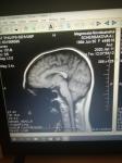 Расшифровка МРТ мозга фото 2