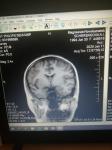 Расшифровка МРТ мозга фото 4